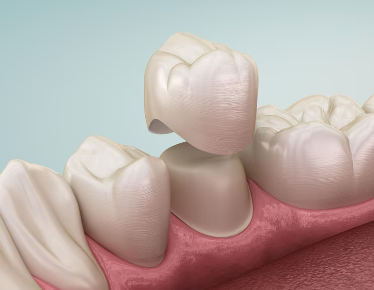 Coroa Dentária: Sinais de que Você Precisa Usar
