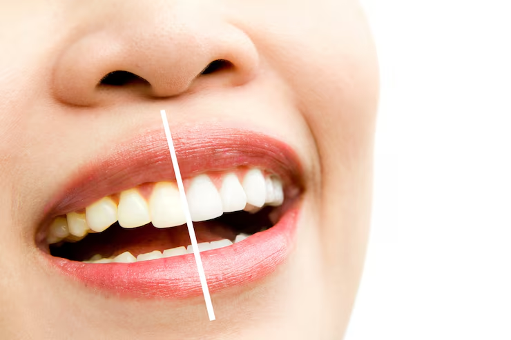 Dentes com manchas de café na esquerda e dentes sem manchas de café na direita